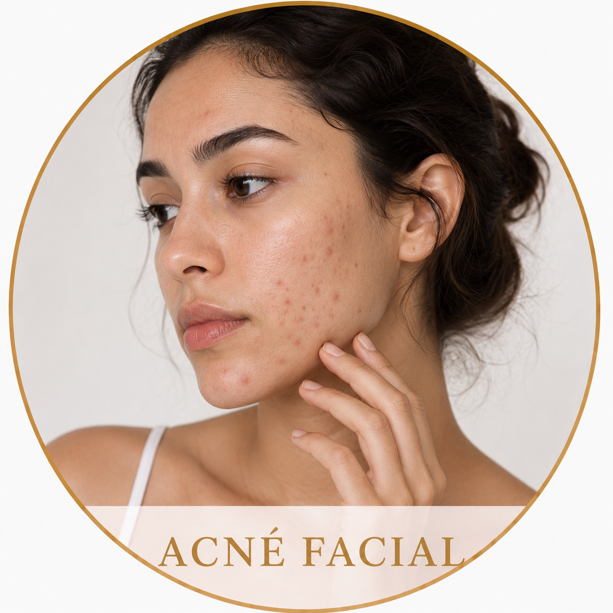 Acné facial