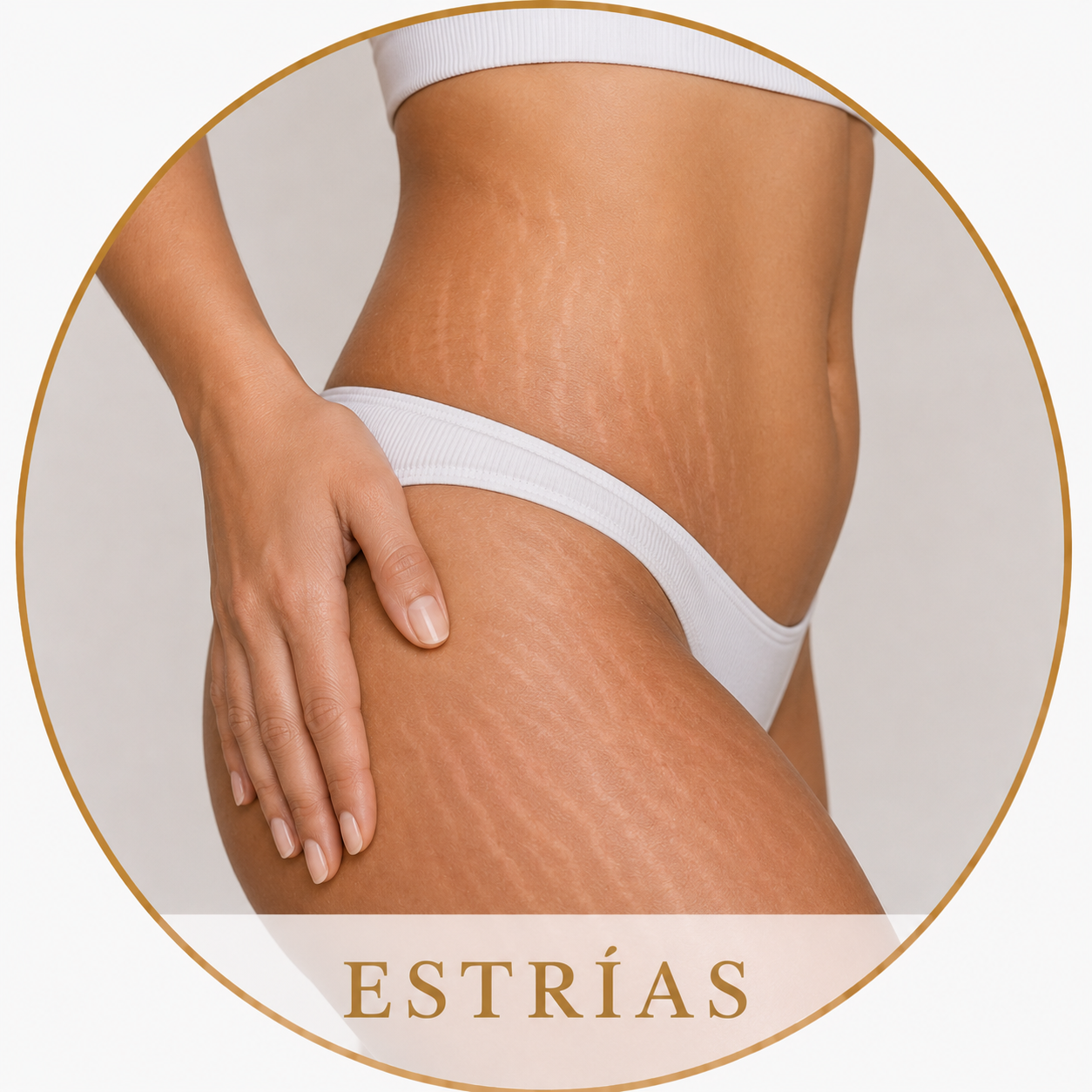 Estrías